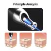 AA-A402 White Portable Laser Pen for Freckle & Mole Removal - 5