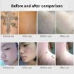 Portable Laser Beauty Instrument - Mole & Freckle Removal Pen, Red Light - 8